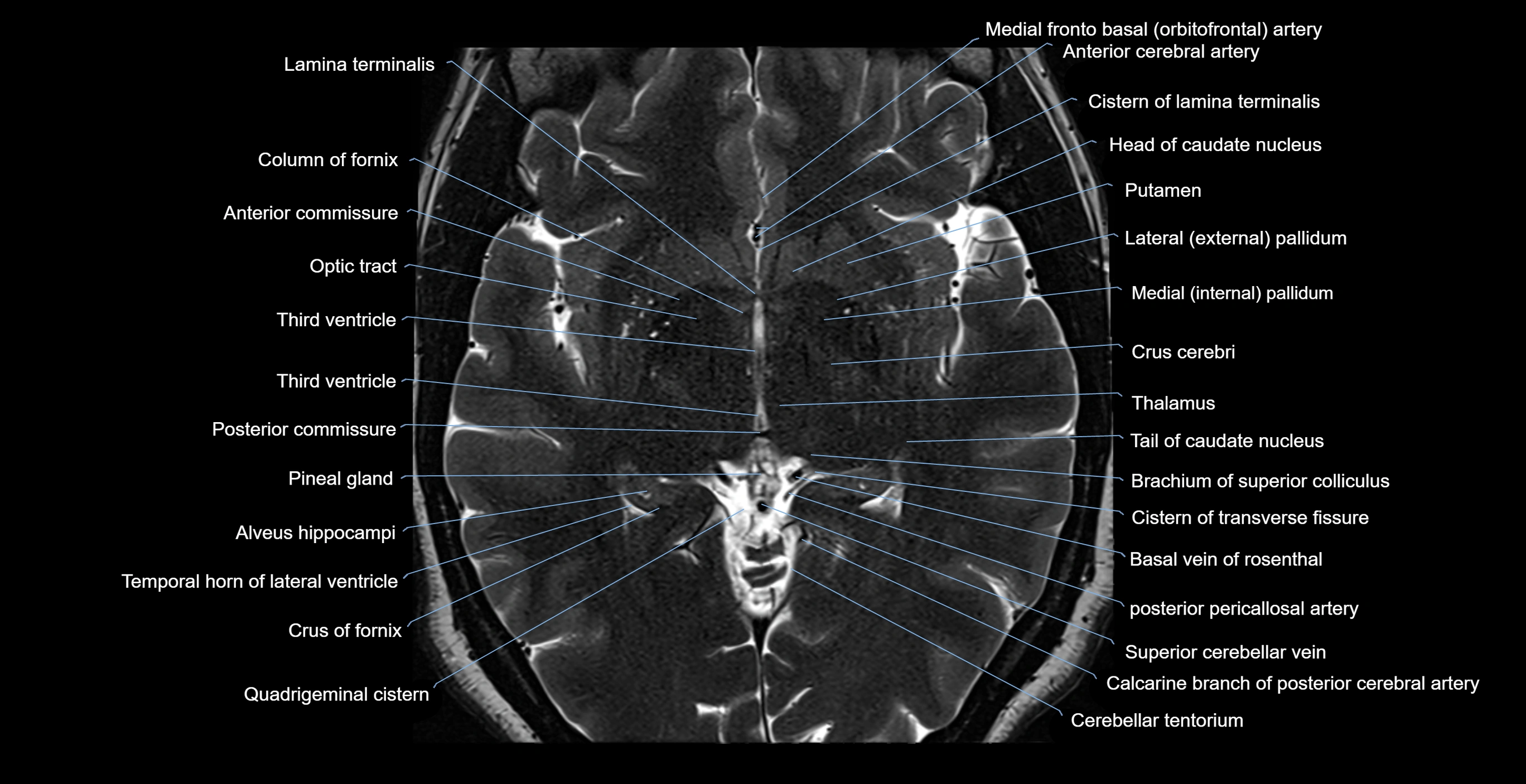 brain axial anatomy 3T MRI images -img-17001-00029.webp